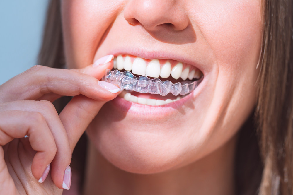 10 Unique Benefits of Invisalign at Alyssa Orthodontics in Gainesville, Sherman, Denison, and Bonham, TX